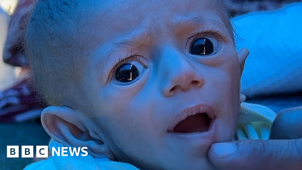 ‘Situation is dire’ – BBC returns to Gaza baby left hungry by Israeli blockade